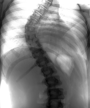 척추측만증 예시 사진